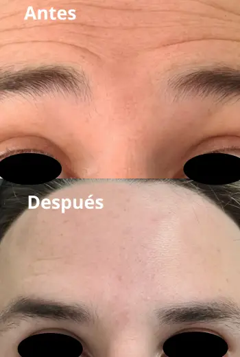 Resultado de armonización facial