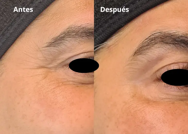 Resultado de tratamiento estético en Black Clinic