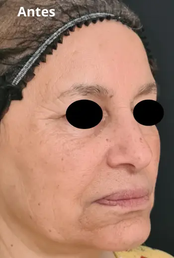Efecto lifting facial Black Clinic