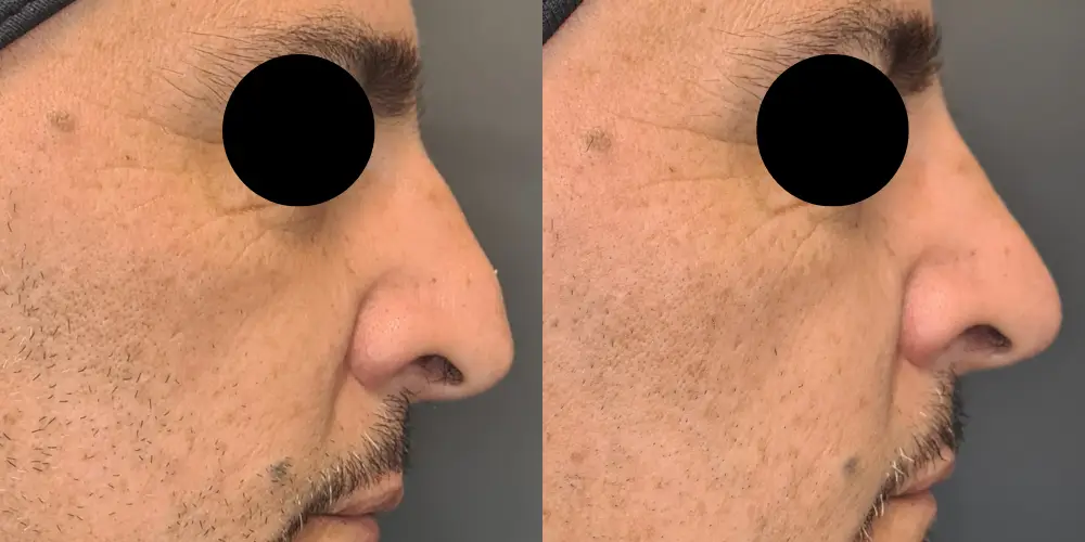Resultado de armonización del perfil nasal